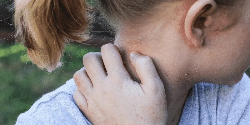 Eczema dans l'oreille eczema oreille