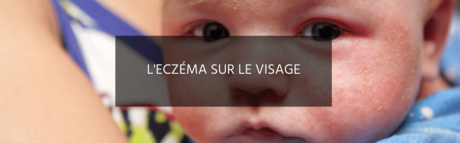 Causes et traitements de l'eczéma sur le visage